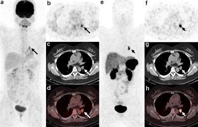 Comparison of diagnostic efficacy of 18F-FDG PET/CT and 68Ga-DOTANOC PET/CT in ectopic adrenocorticotropic hormone syndrome